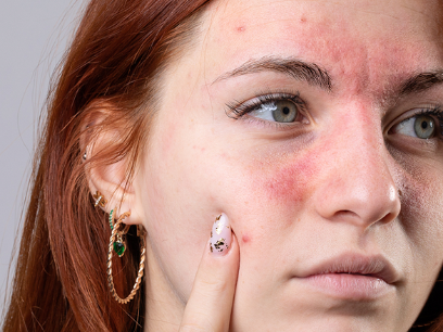 155.-como-combatir-la-rosacea-dermatologa-natalia-jimenez