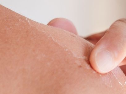 369.-tipos-quemaduras-solares-como-evitarlas