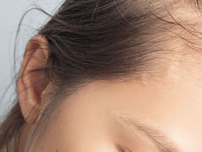 225.-la-caida-del-cabello