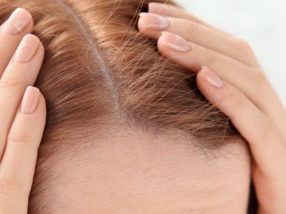 38.-caida-de-pelo-hormonal-por-que-se-produce