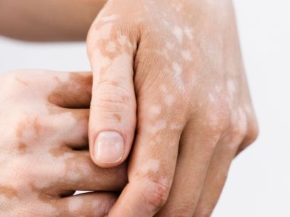 2.-manchas-rojas-en-la-piel-por-que-aparecen-y-como-tratarlas