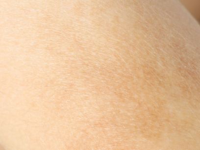 33.-niacinamida-que-es-manchas