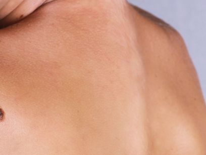 81.-tratar-manchas-despigmentacion-piel