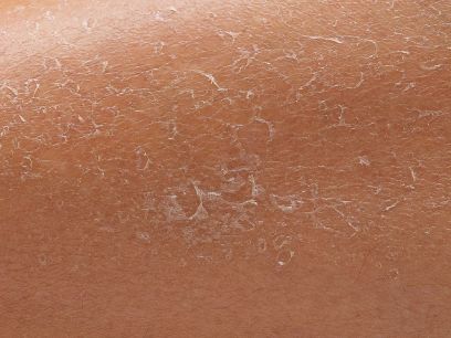 382.-cancer-de-piel-incidencia-melanoma-espana