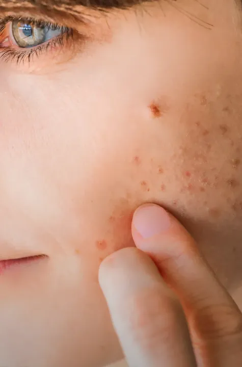 2.Biretix_TRIPLE IMAGE_Acne_713x1080