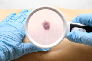 melanoma-y-proteccion-solar