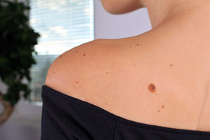 Melanoma-y-proteccion-solar