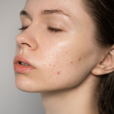 IMG+TEXT_432x432-ACNE