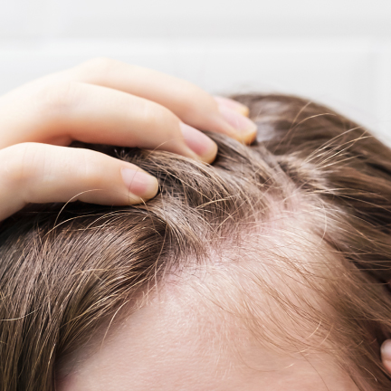 IMG+TEXT_432x432_alopecia 1