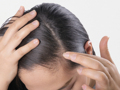 Beneficios_Caspa_400 × 300_Descamacion-