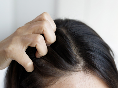 Beneficios_pelo graso _400x400_dermatitis